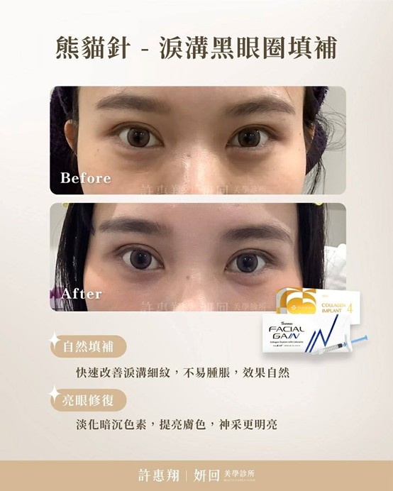 熊貓針改善淚溝黑眼圈