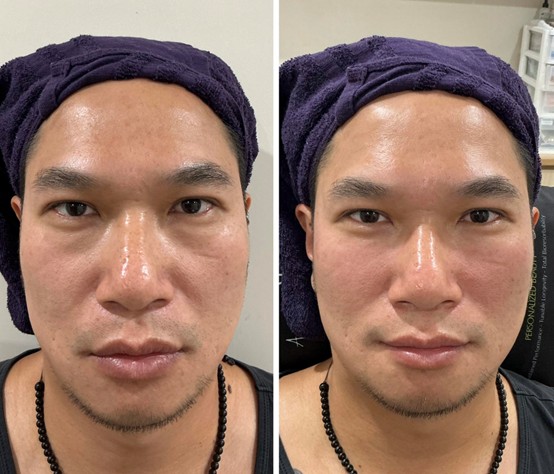 壯碩型男淚溝治療案例