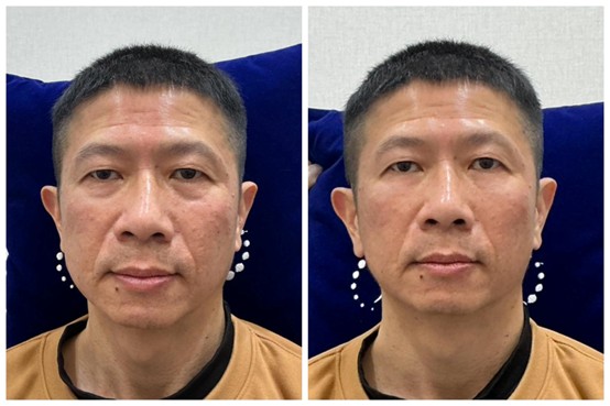 眼周黑眼圈淚溝治療案例