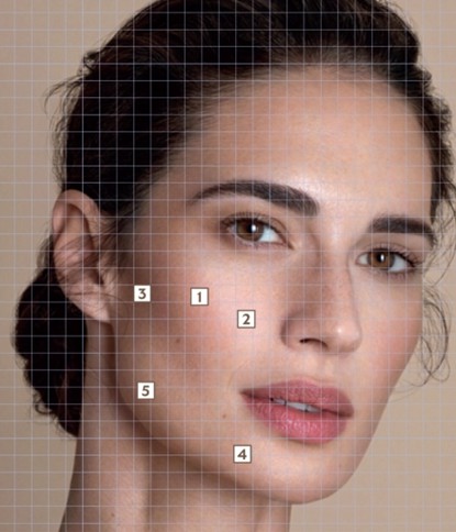 BAP注射點位示意