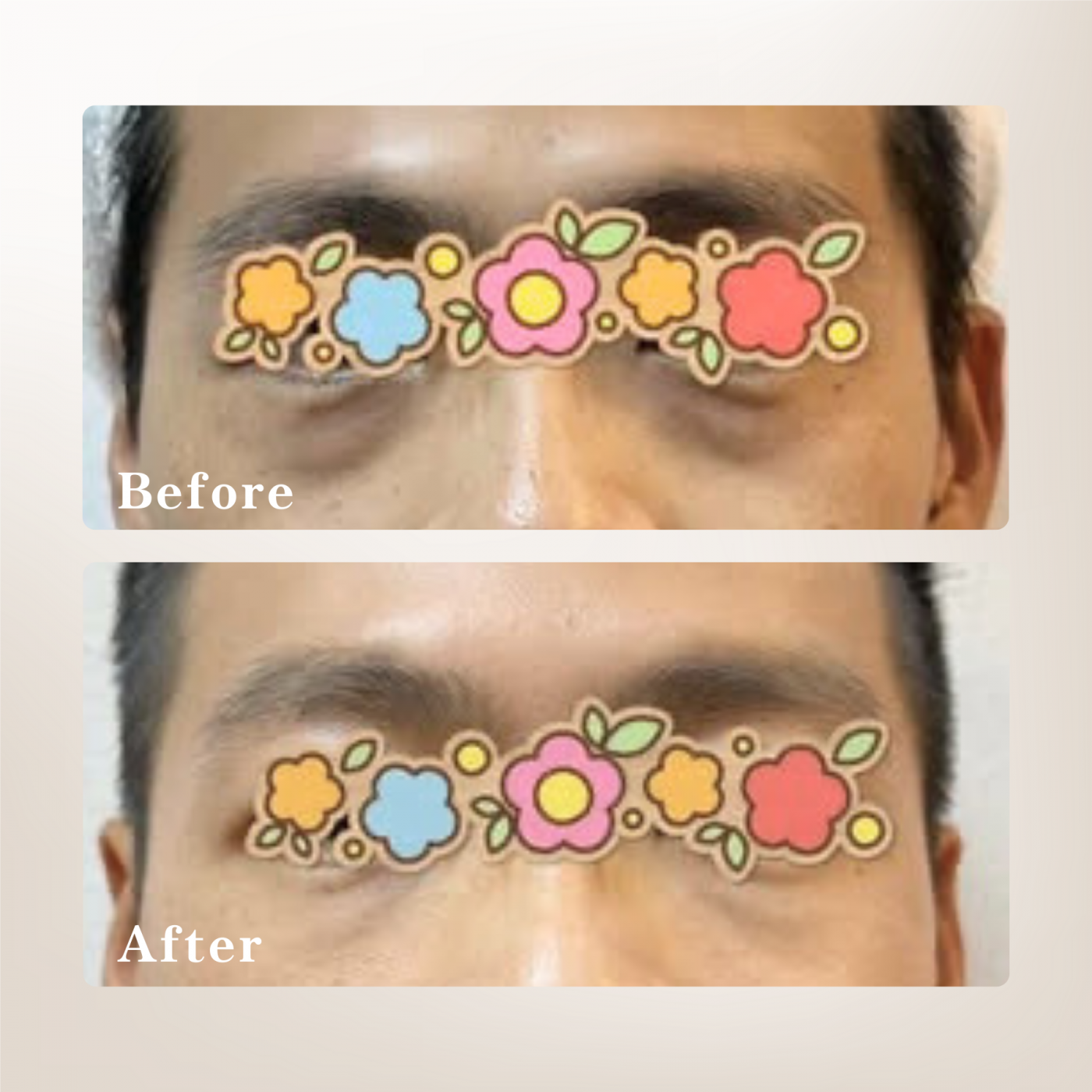 男性淚溝填充術後案例