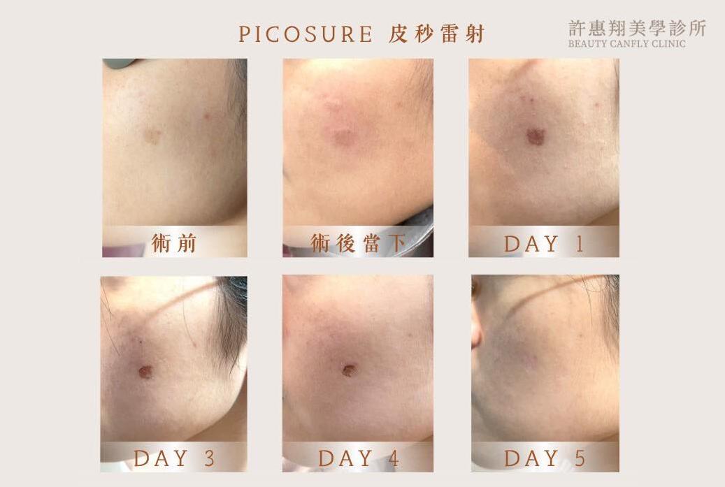 PicoSure皮秒雷射一週過程效果圖