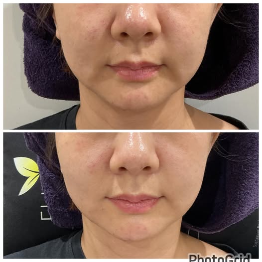 木偶紋治療示意圖