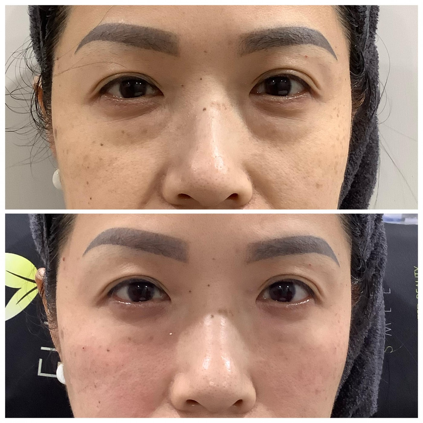 產後媽咪年輕化治療案例