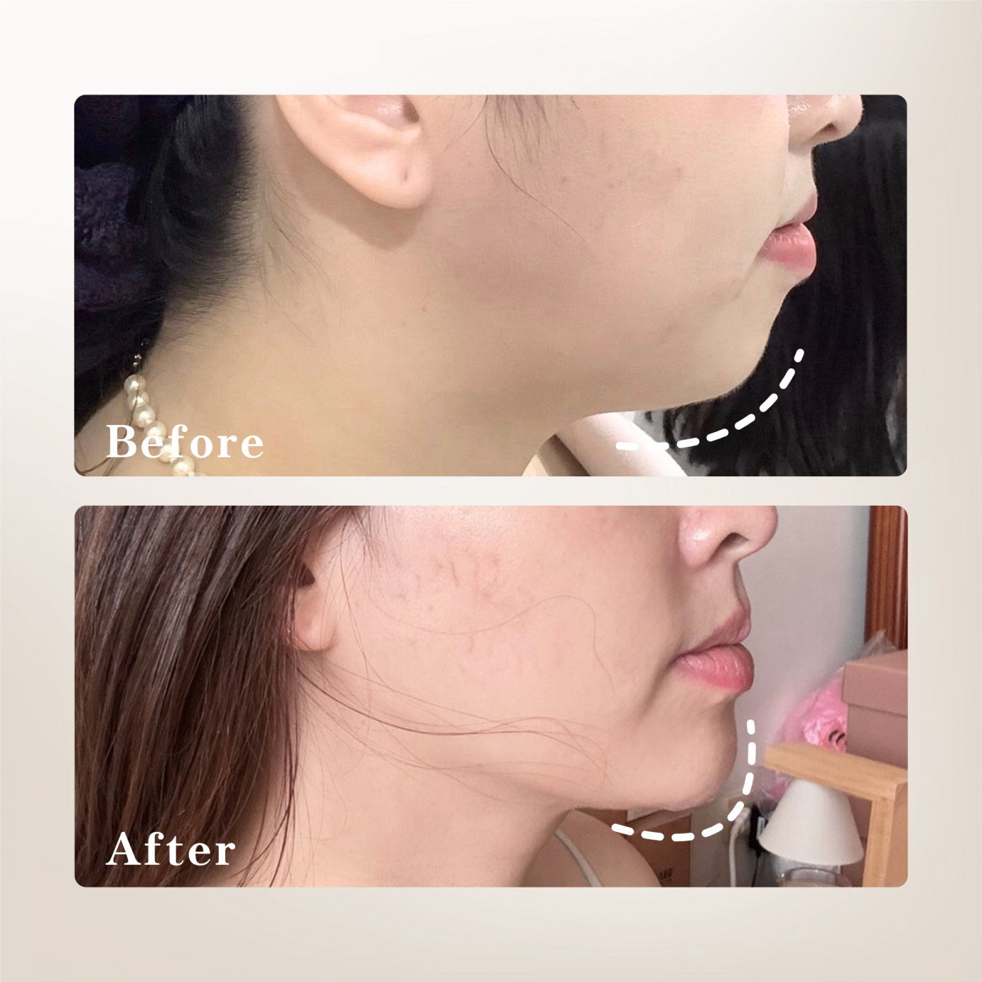 下顎線美學情境圖