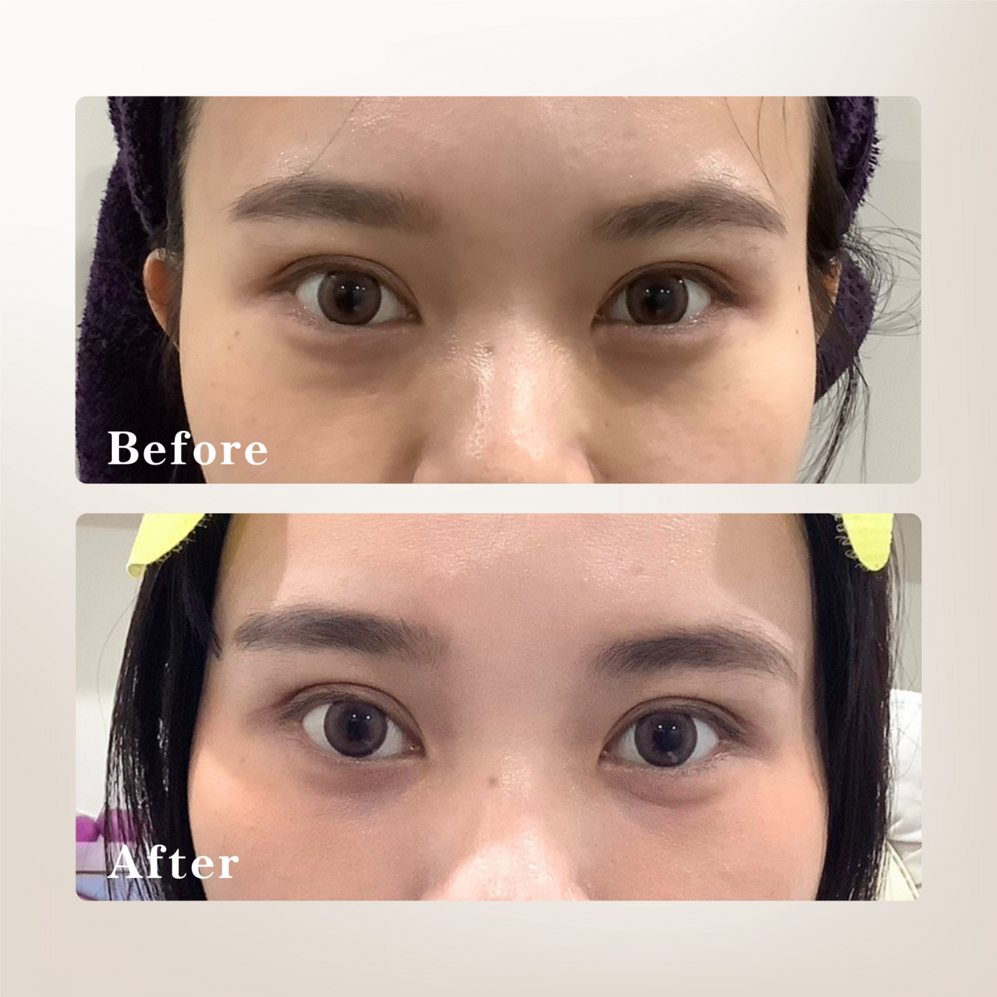 熊貓針改善淚溝黑眼圈