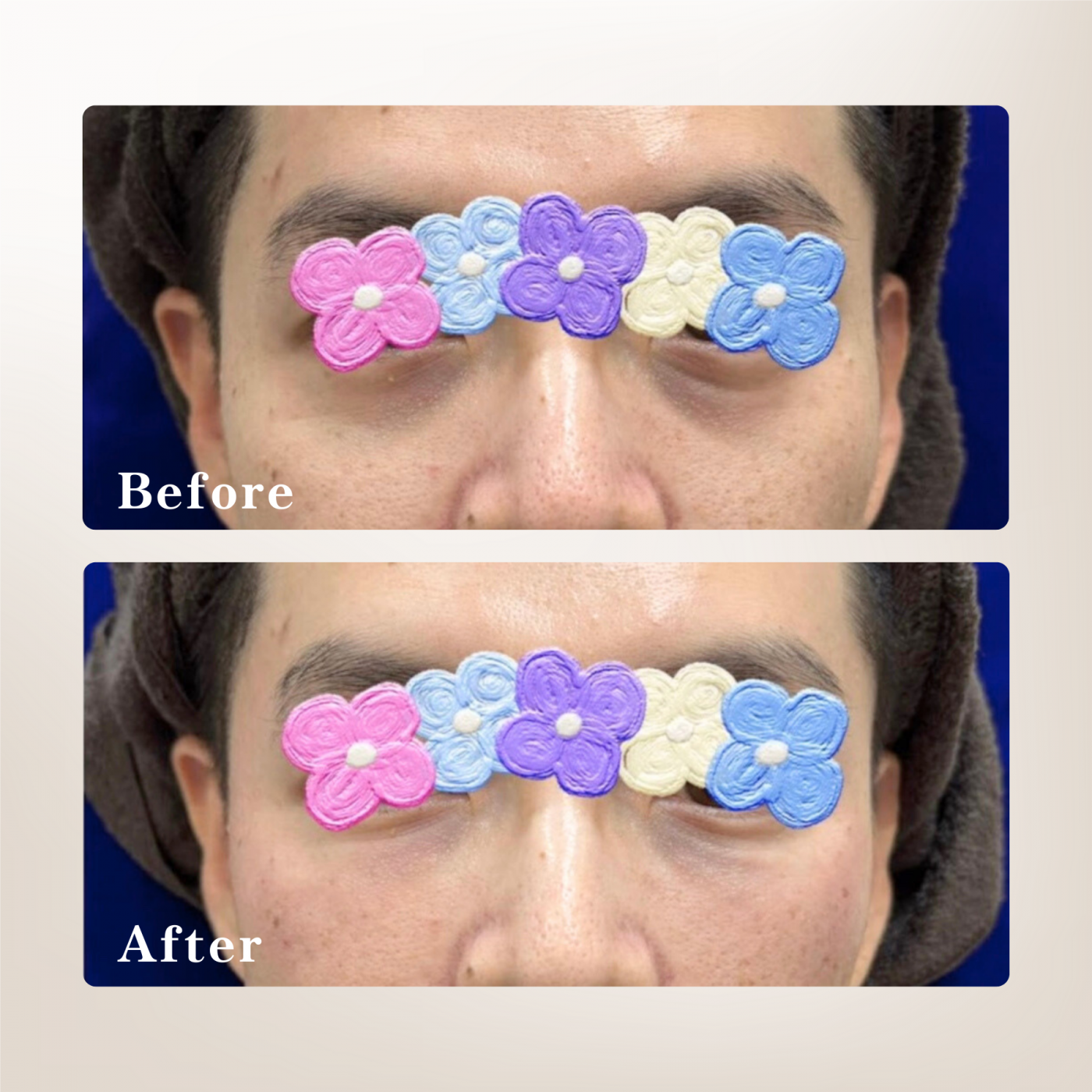 工程師黑眼圈治療前後對比