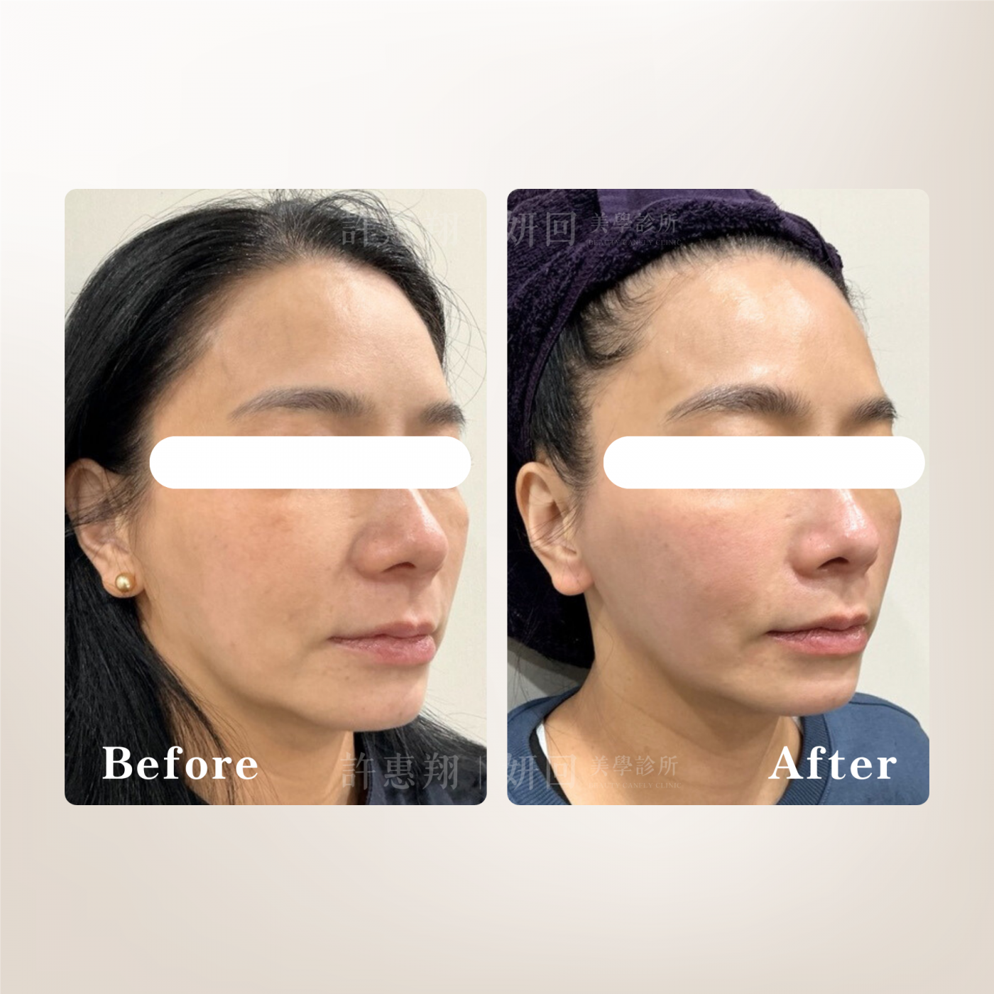 媚必提治療效果展示