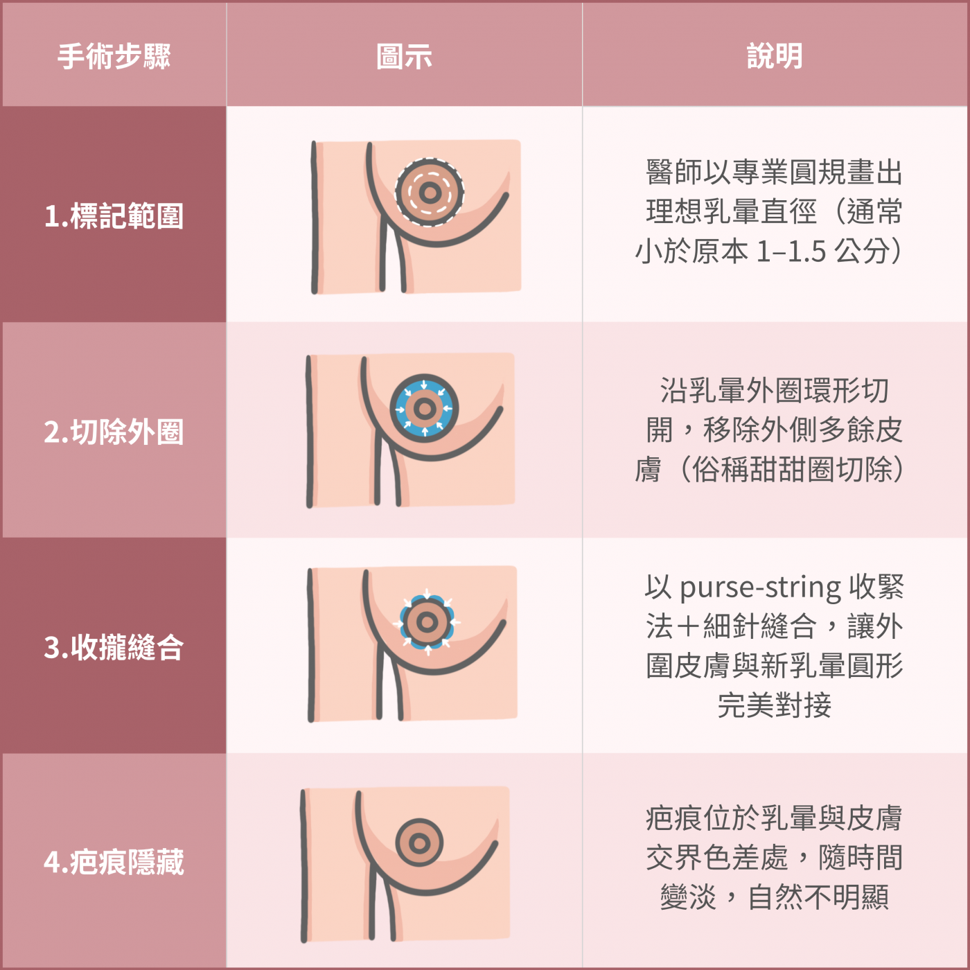 乳暈縮小手術示意圖