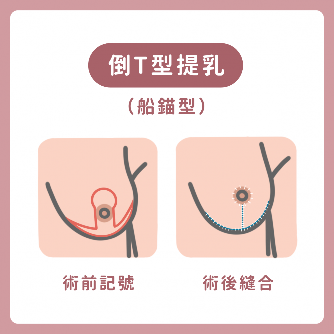 倒T式縮乳（船錨型）切口示意圖｜乳暈+垂直+乳下緣切口｜妍回美學診所