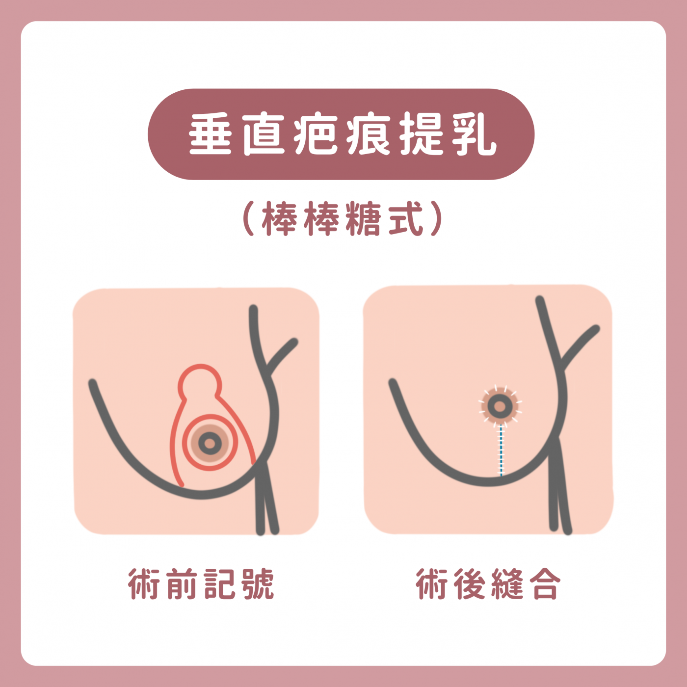 棒棒糖式縮乳切口示意圖｜乳暈+垂直直線、無乳下橫疤｜妍回美學診所