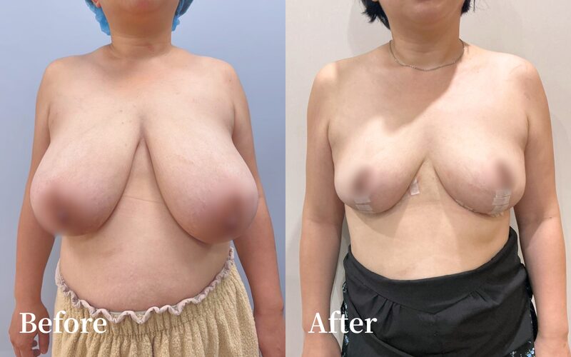 重度乳房肥大合併哺乳後下垂｜F→C 罩杯倒T式縮乳手術真實案例｜陳尹陽 ＋ 廖啟佑醫師主刀｜妍回美學診所