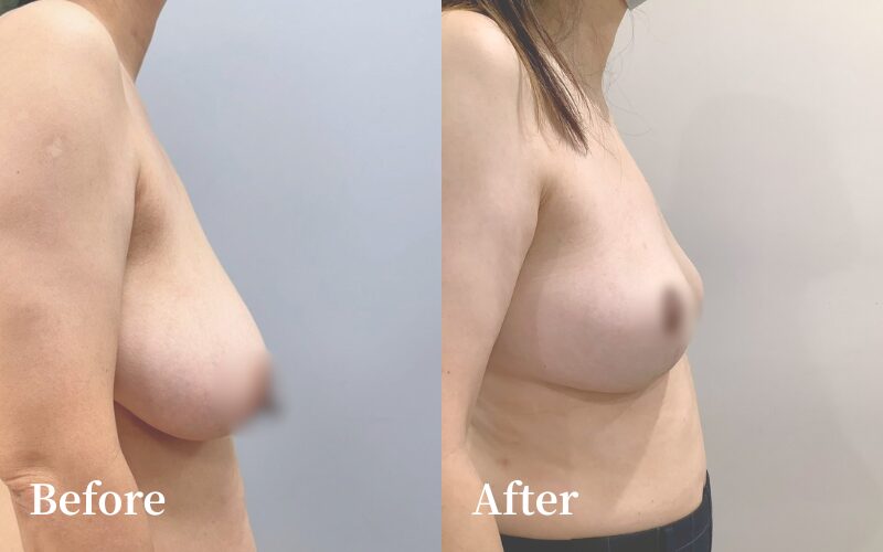 65 歲長期乳房下垂｜棒棒糖式縮乳手術真實案例｜陳尹陽 ＋ 廖啟佑醫師主刀｜妍回美學診所