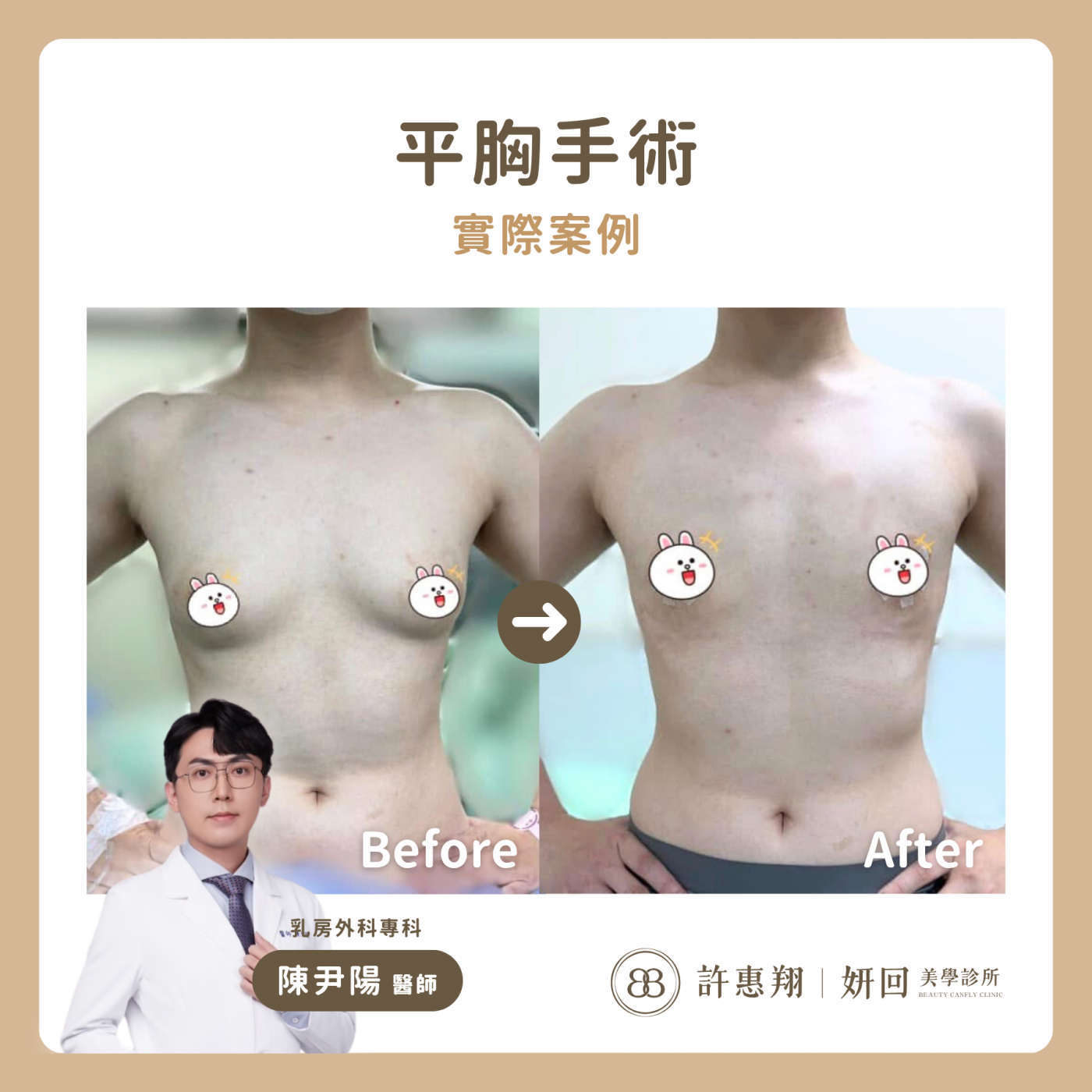 平胸手術前後對比示意圖