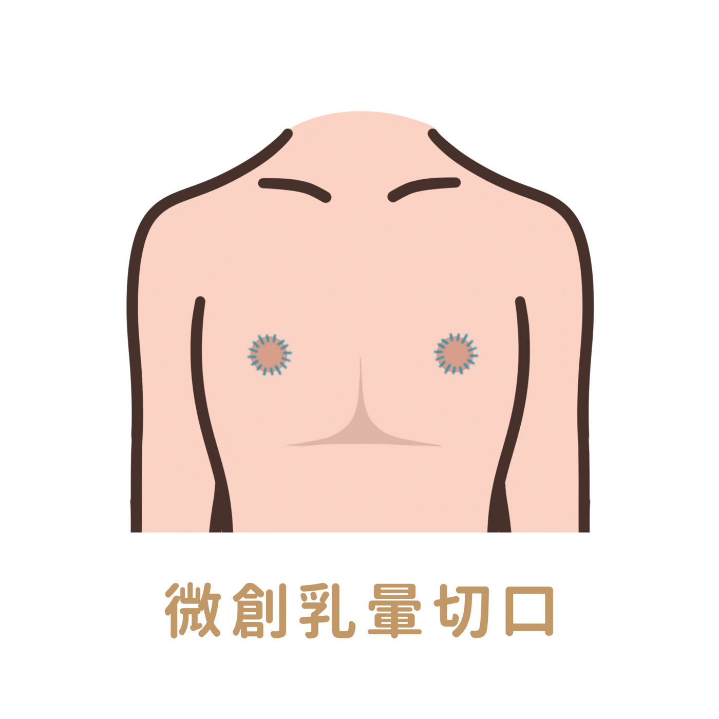 微創乳暈切口平胸手術特色