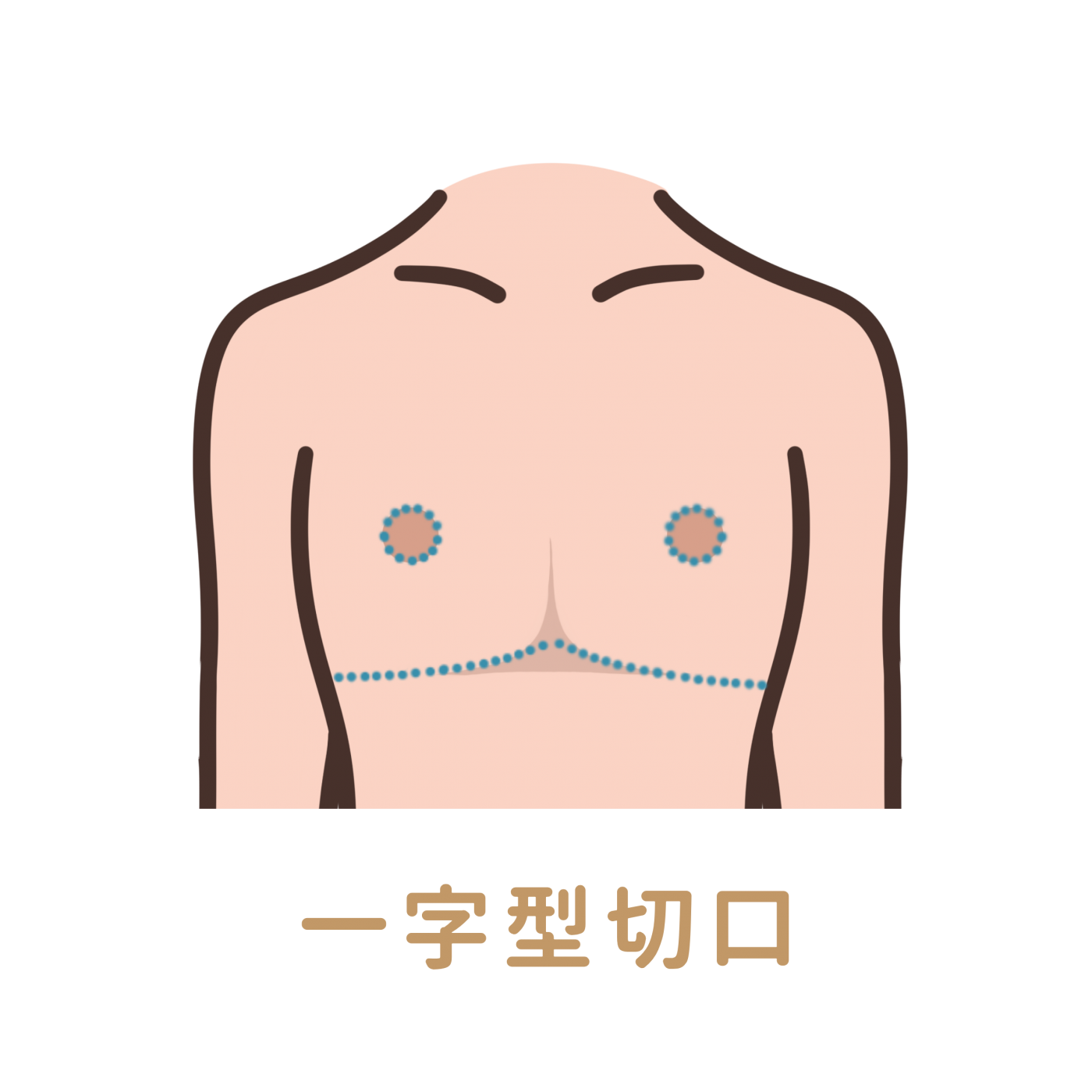 一字型平胸手術特色