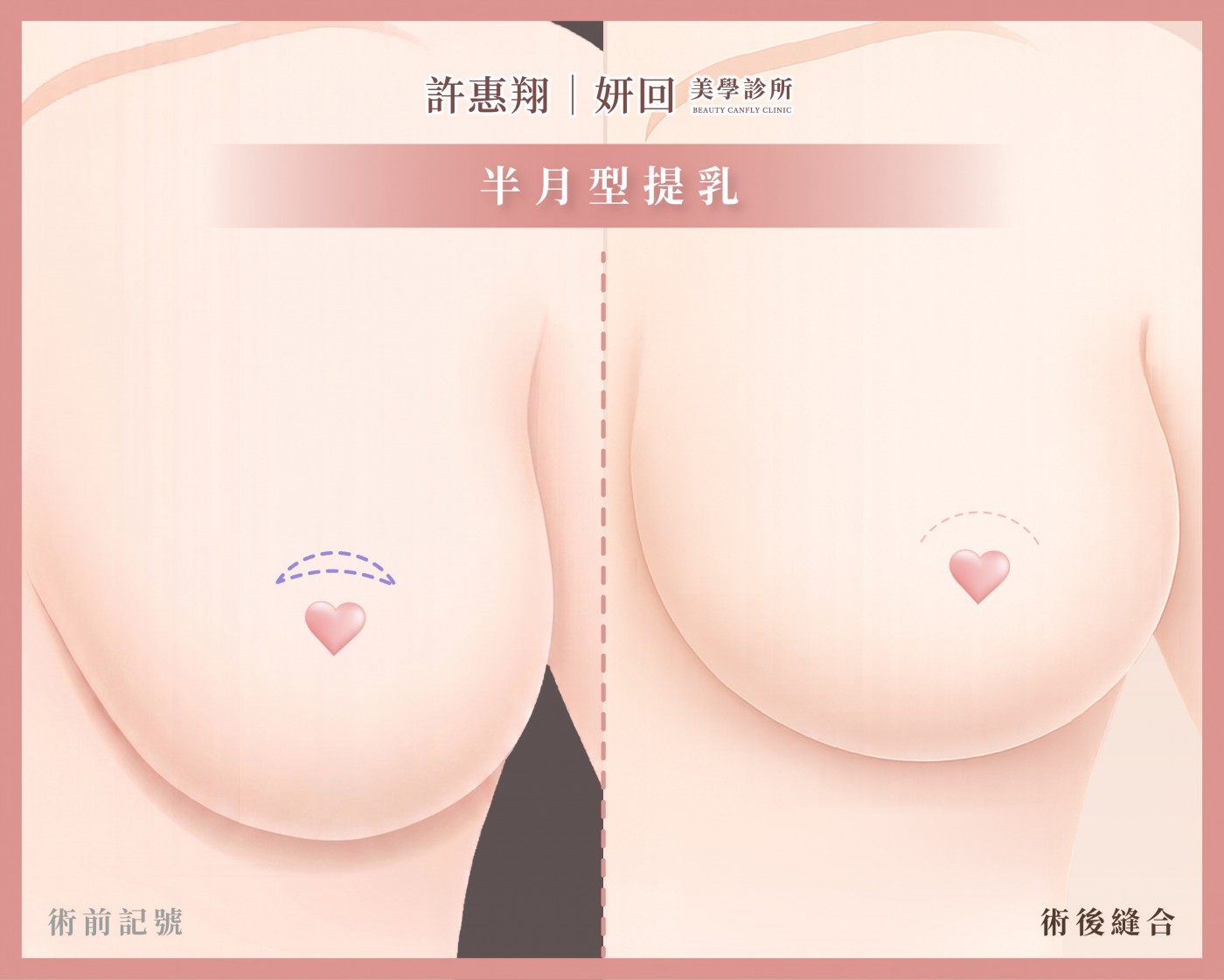 半月形提乳切口示意圖｜乳暈上緣新月形切口｜微創隱蔽｜妍回美學診所