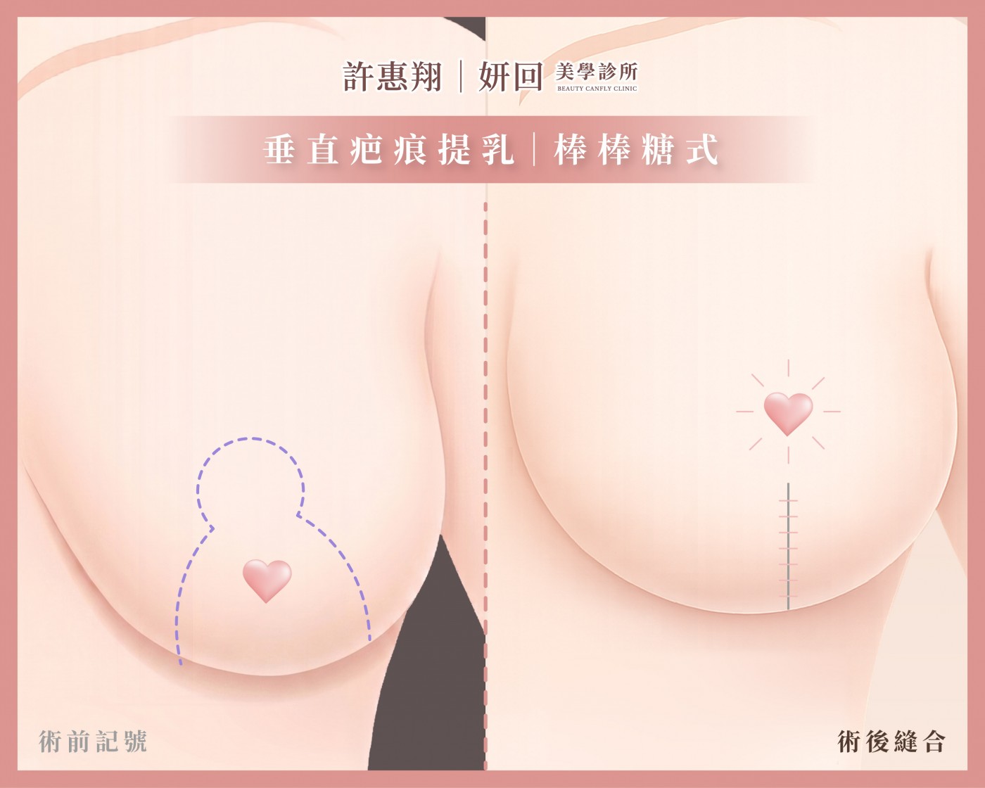 棒棒糖式提乳切口示意圖｜乳暈+垂直直線、無乳下橫疤｜中度下垂首選｜妍回美學診所