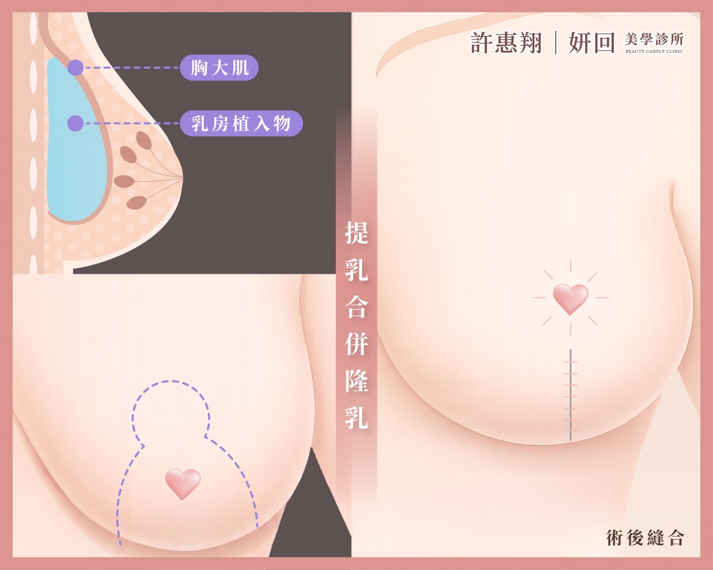 提乳合併隆乳手術示意圖｜果凍矽膠植入物胸大肌下置入｜妍回美學診所