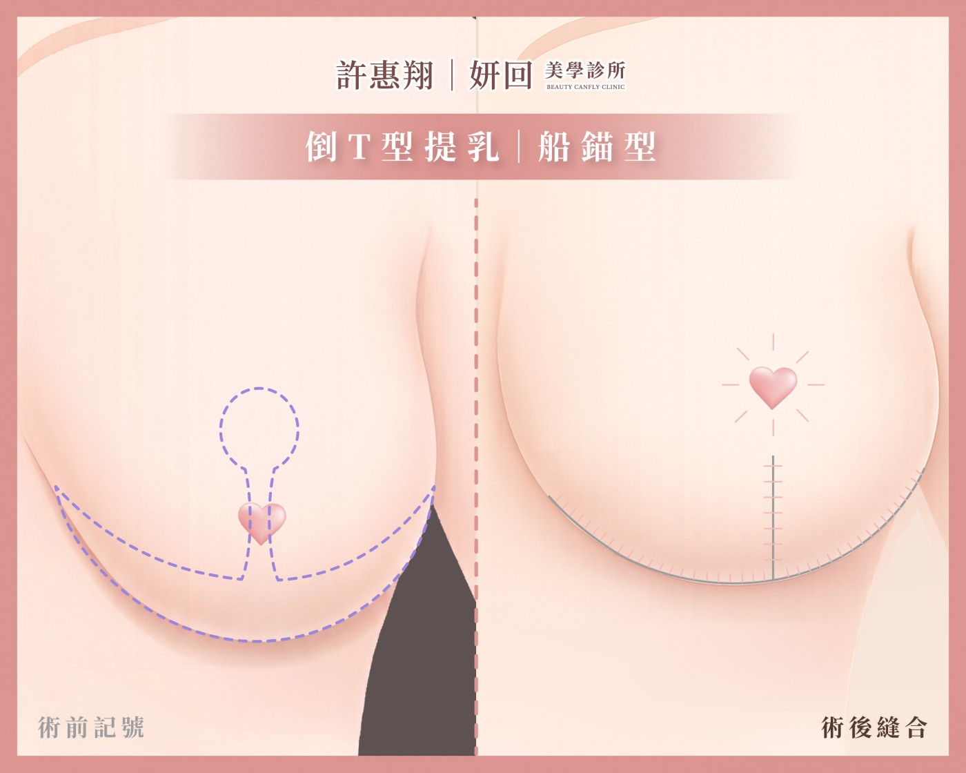 倒T式提乳切口示意圖｜重度下垂、皮膚嚴重多餘案例｜船錨型切口｜妍回美學診所