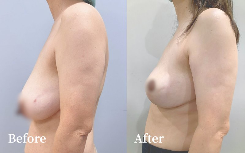 單純提乳 術前術後側面對照｜經本人同意刊登｜妍回美學診所