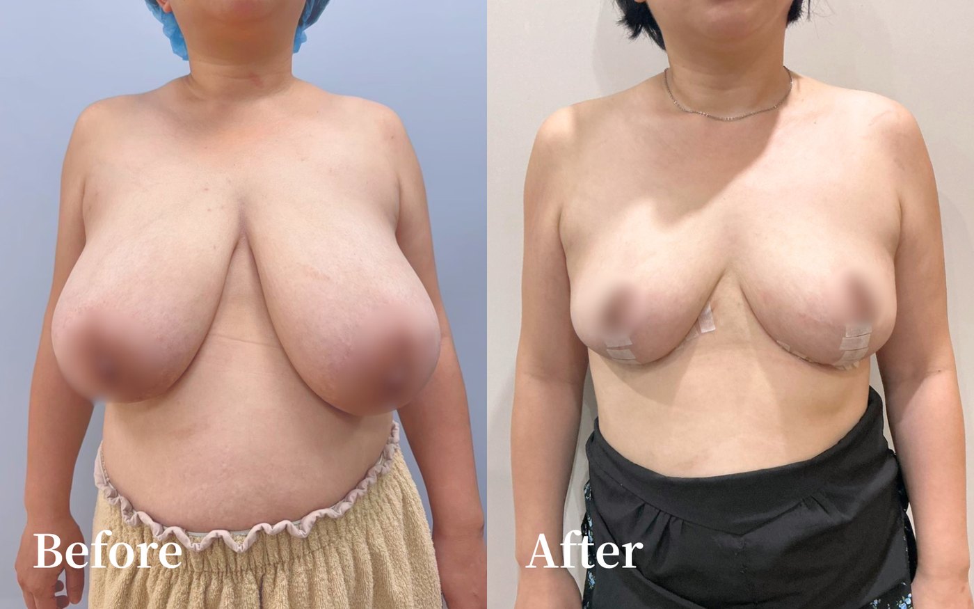 倒T式提乳合併縮乳 術前術後正面對照｜經本人同意刊登｜妍回美學診所