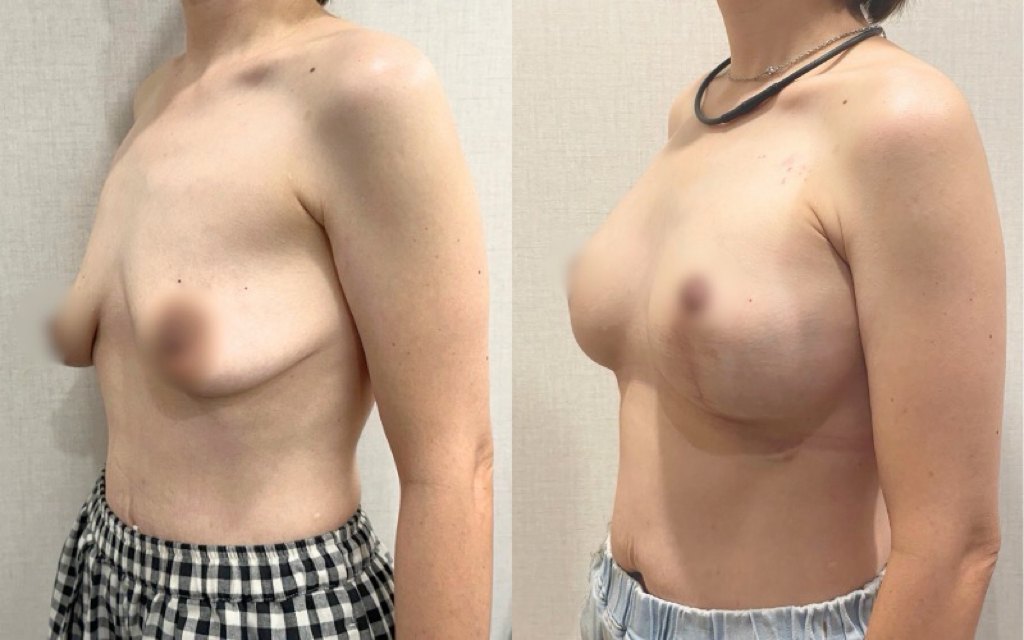 提乳合併隆乳 術前術後斜側面對照｜經本人同意刊登｜妍回美學診所