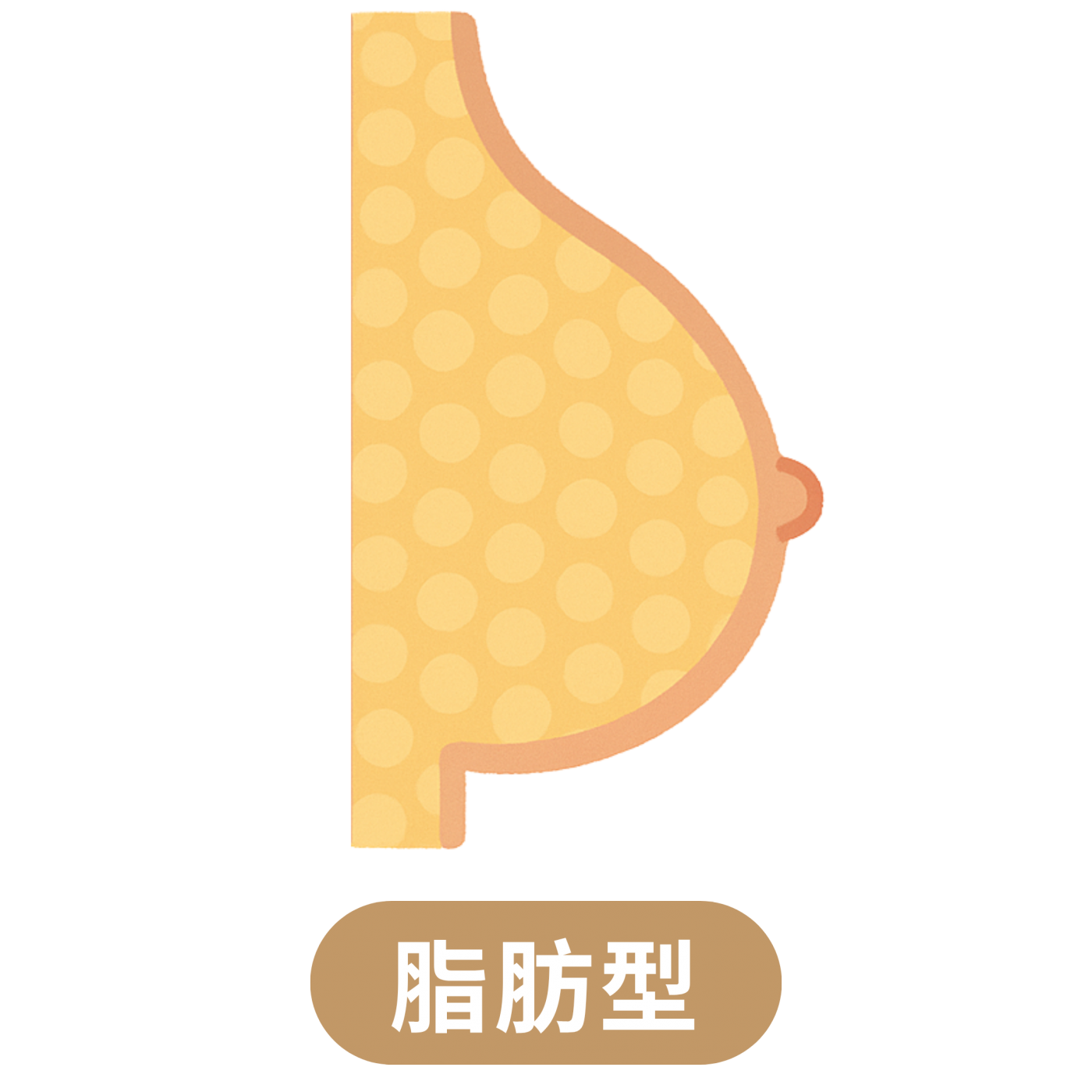 脂肪型假性女乳症示意圖