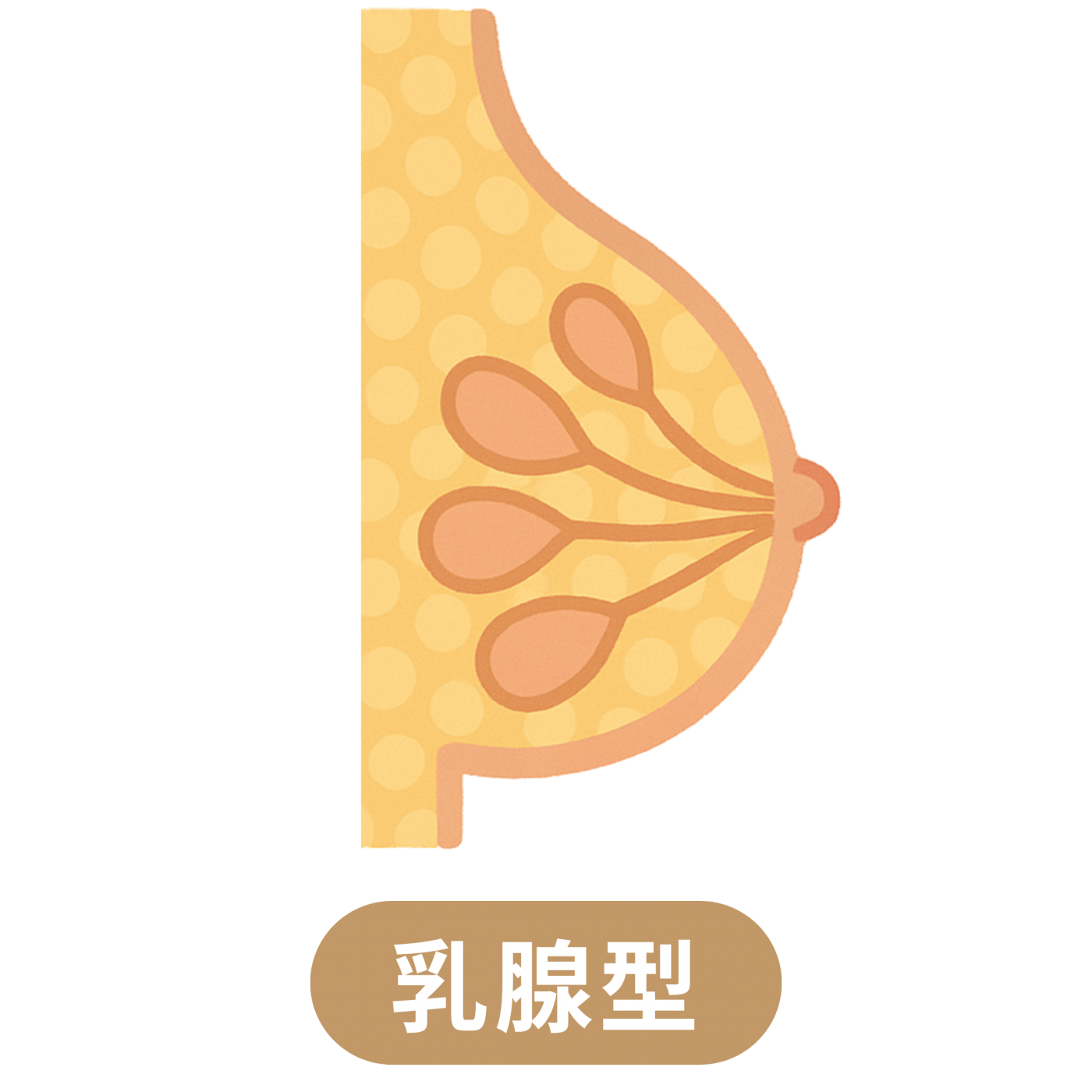 乳腺型真性女乳症示意圖