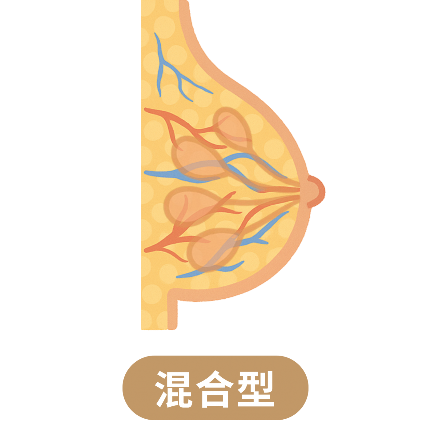 混合型男性女乳症示意圖