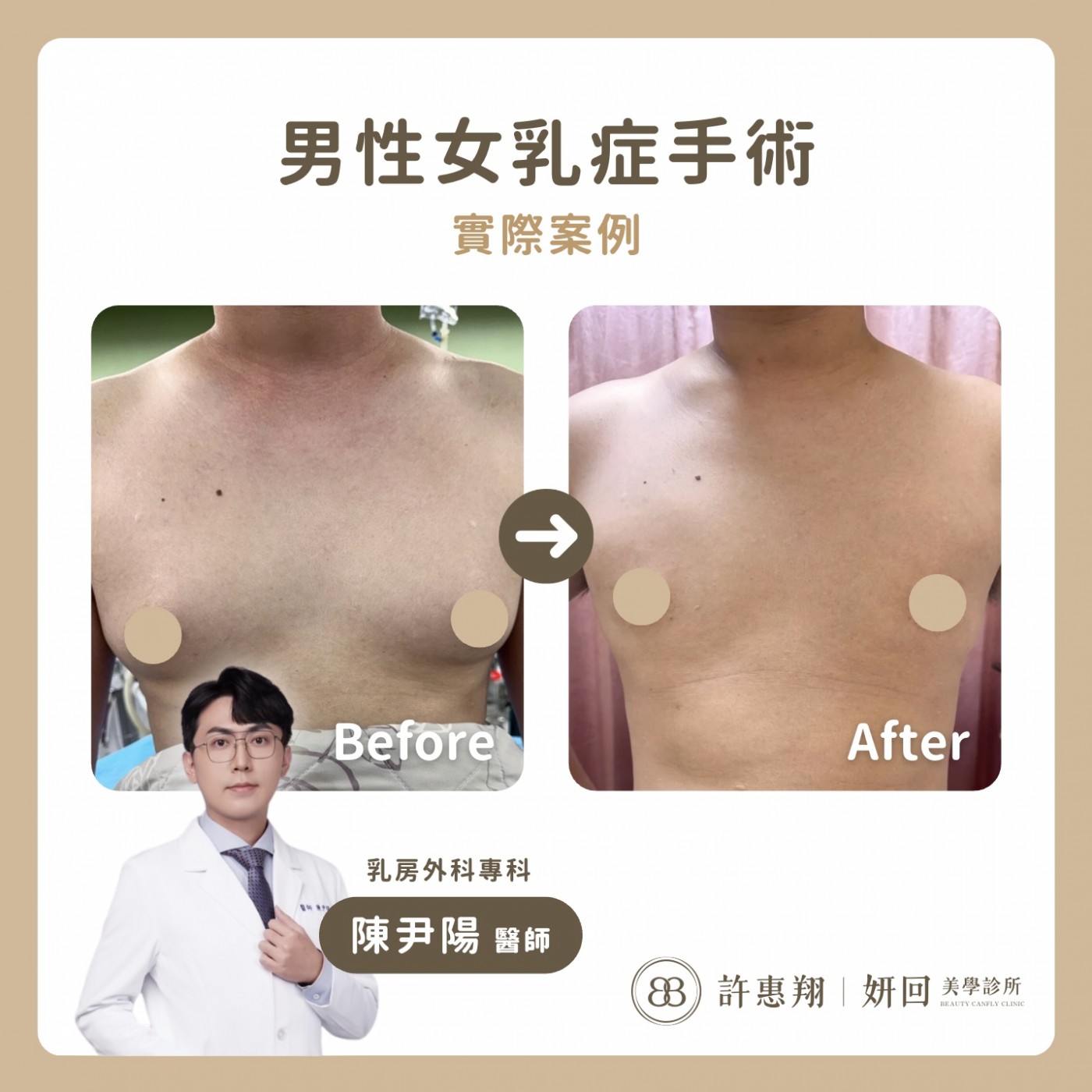 女乳症手術優勢-乳腺切除與抽脂