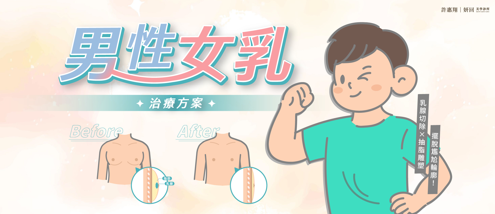 男性女乳症電腦版 BANNER