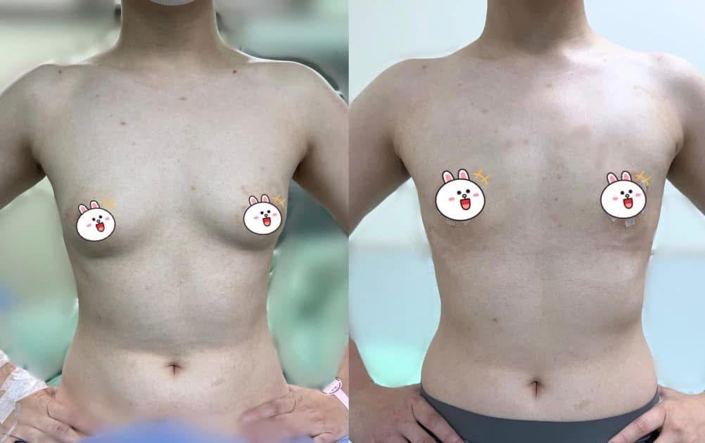 男性女乳症 / 平胸手術案例｜乳暈傷口微創開刀術前術後對比｜陳尹陽 ＋ 廖啟佑醫師主刀｜妍回美學診所