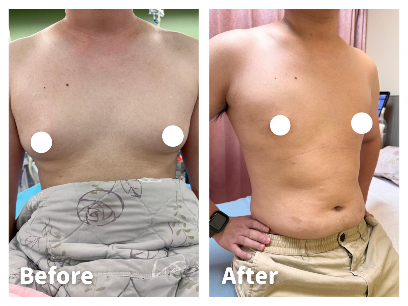 男性女乳症手術案例｜30歲健身工程師術前外突鬆軟術後平整結實｜陳尹陽醫師主刀｜妍回美學診所
