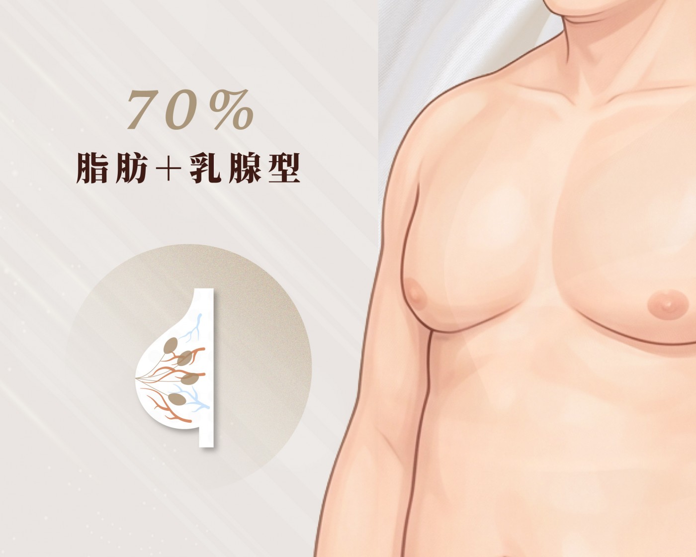 類型A 圖|脂肪加乳腺型男性女乳症示意|妍回美學診所