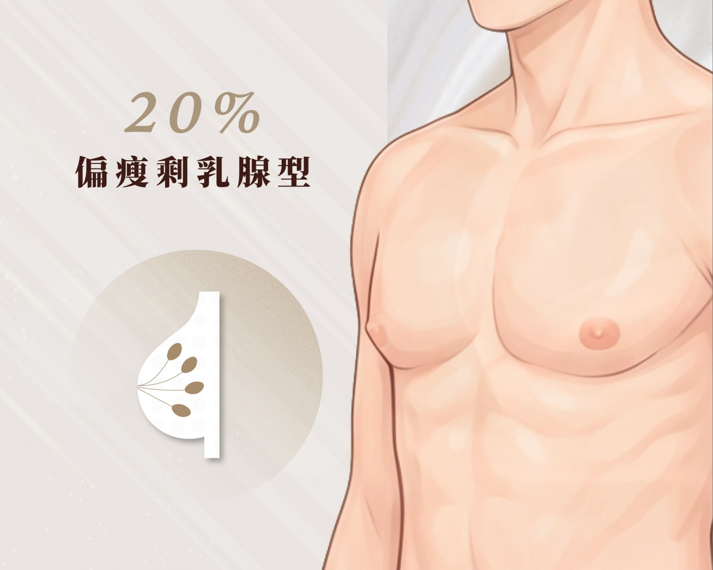 類型B 圖|偏瘦剩乳腺型男性女乳症示意|妍回美學診所