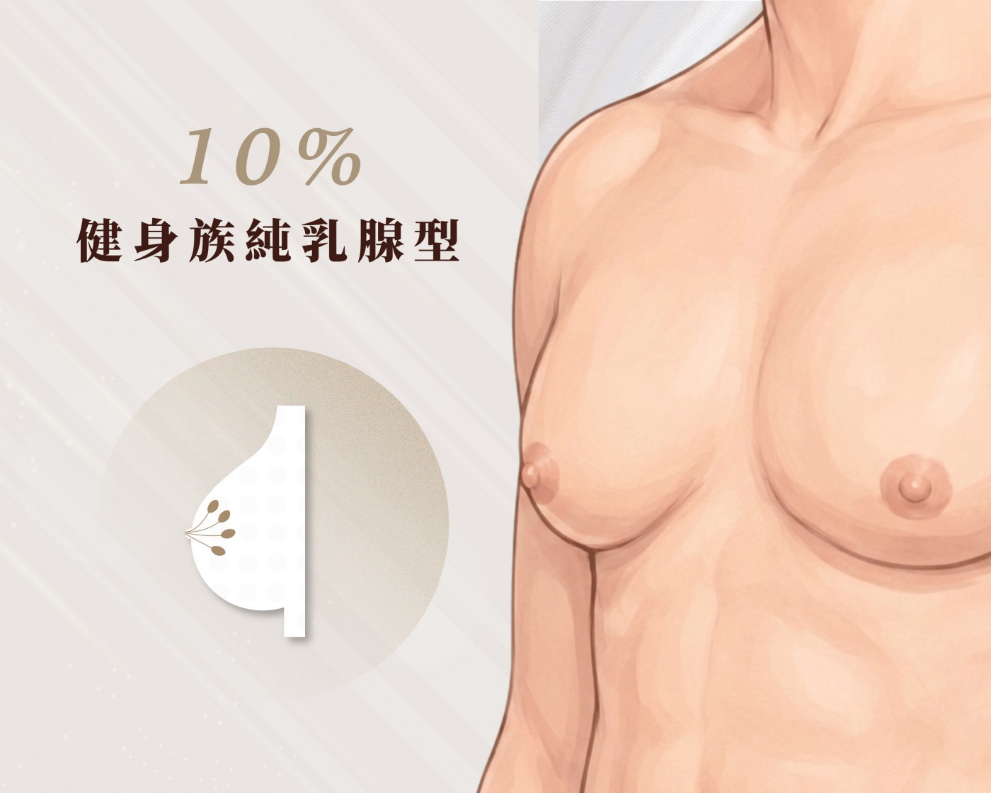 類型C 圖|健身族純乳腺型男性女乳症示意|妍回美學診所