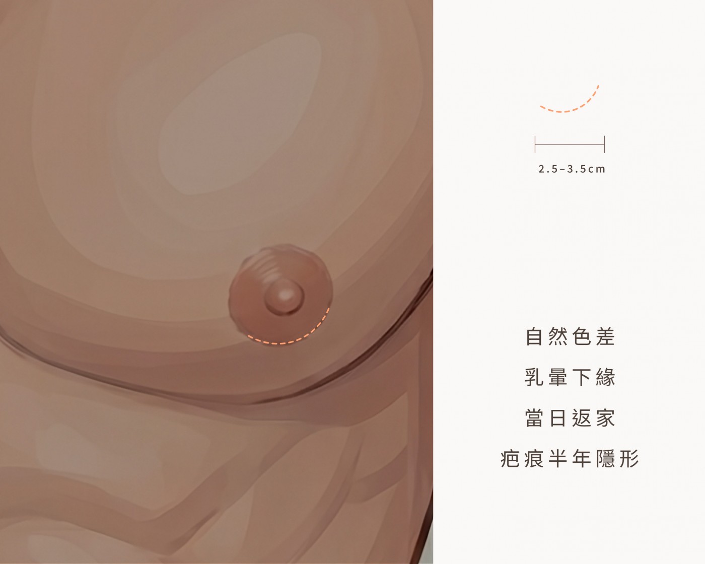乳暈半圈隱痕切口示意圖|妍回美學診所