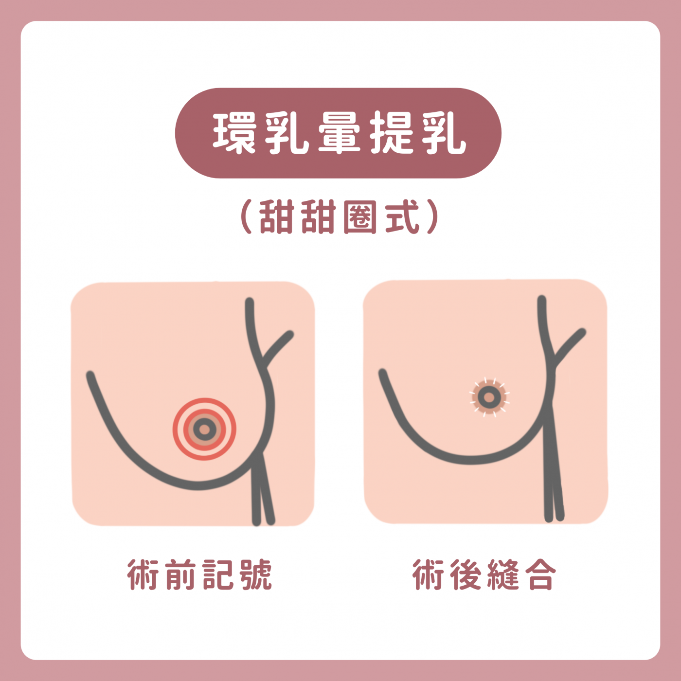 環乳暈提乳手術示意圖
