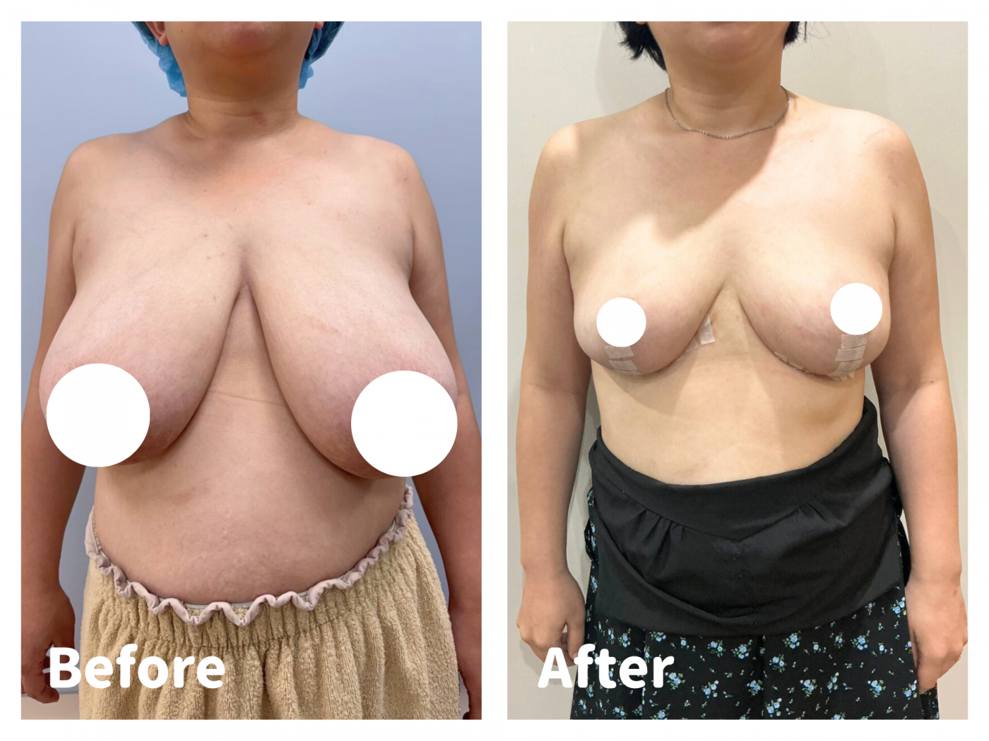 縮乳提乳術後身心轉變