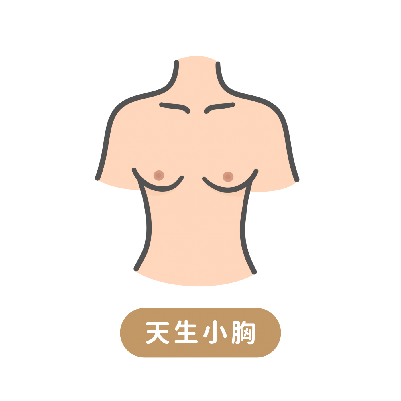 天生小胸隆乳手術示意圖
