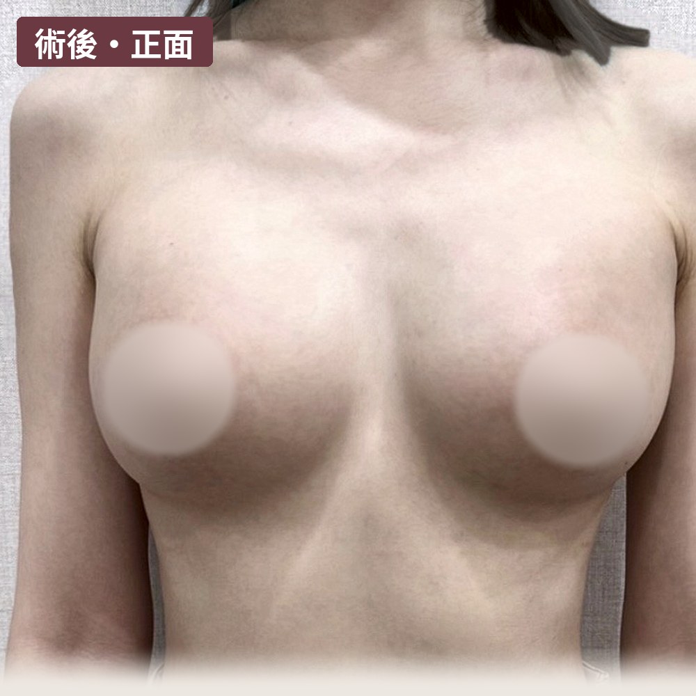 女王波隆乳 術後 1 個月正面（肩膀到腰）：上胸飽滿、乳溝靠攏｜經本人同意刊登｜妍回美學診所