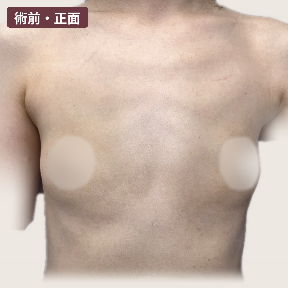 女王波隆乳 術前正面（肩膀到腰）：胸部容積少、上胸扁平｜經本人同意刊登｜妍回美學診所