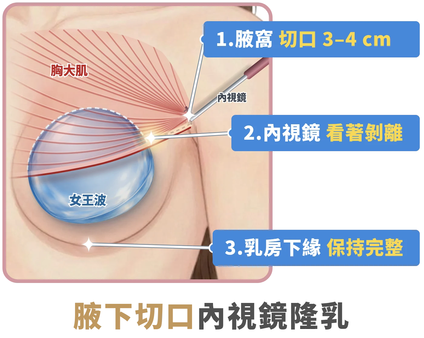 女王波腋下內視鏡隆乳半透視圖：腋窩切口 3–4 公分，內視鏡看著剝離，女王波放入胸大肌下的雙平面，乳房下緣保持完整｜妍回美學診所