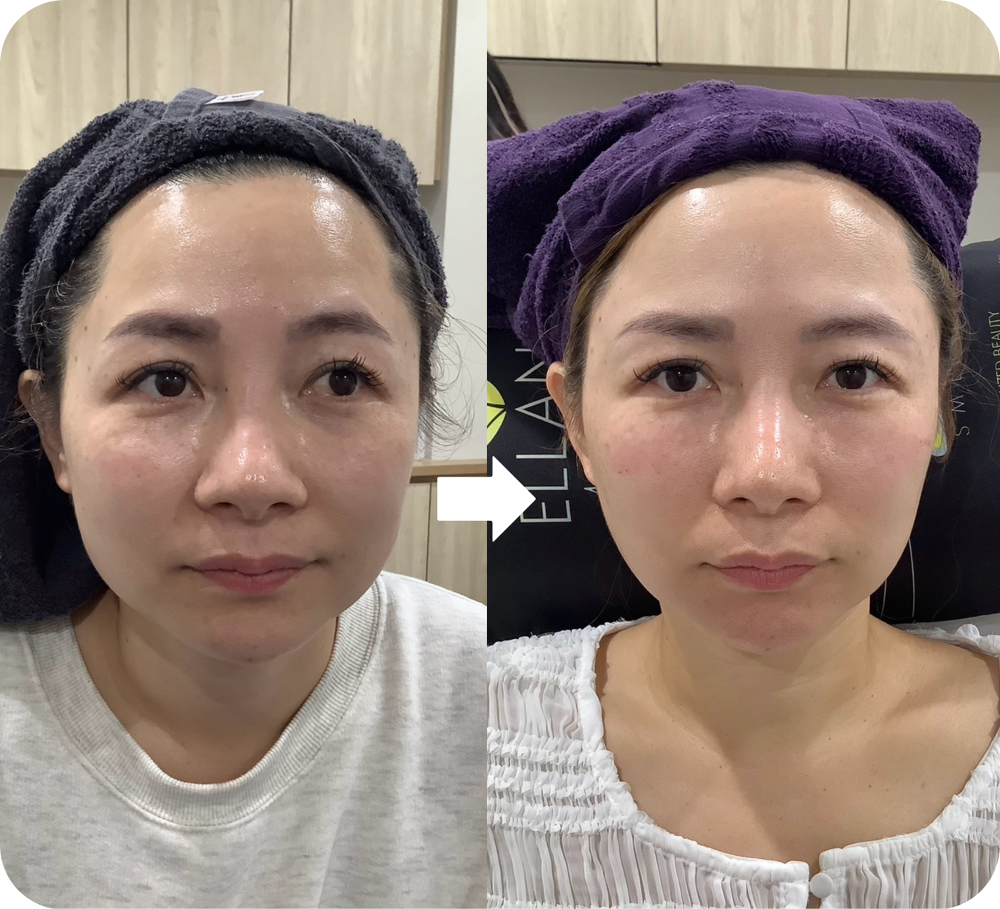 海芙音波媚必提正面輪廓療程前後對照｜中下臉收攏與下顎線變化