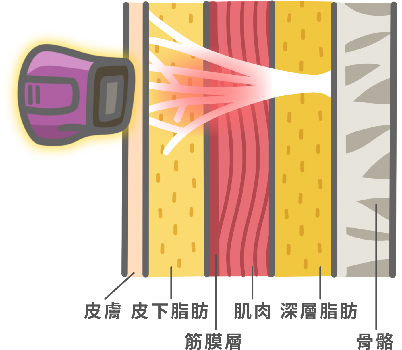 鳳凰電波施打方式