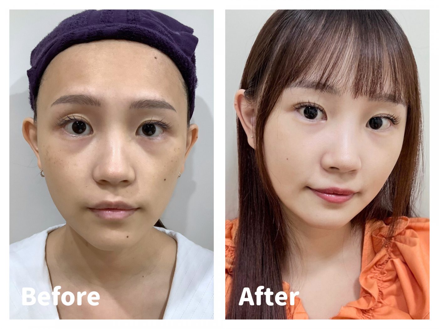 黑眼圈全面改善方案真實案例｜結構型黑眼圈合併淚溝｜玻尿酸+G4 熊貓針複合療程｜許惠翔醫師｜妍回美學診所