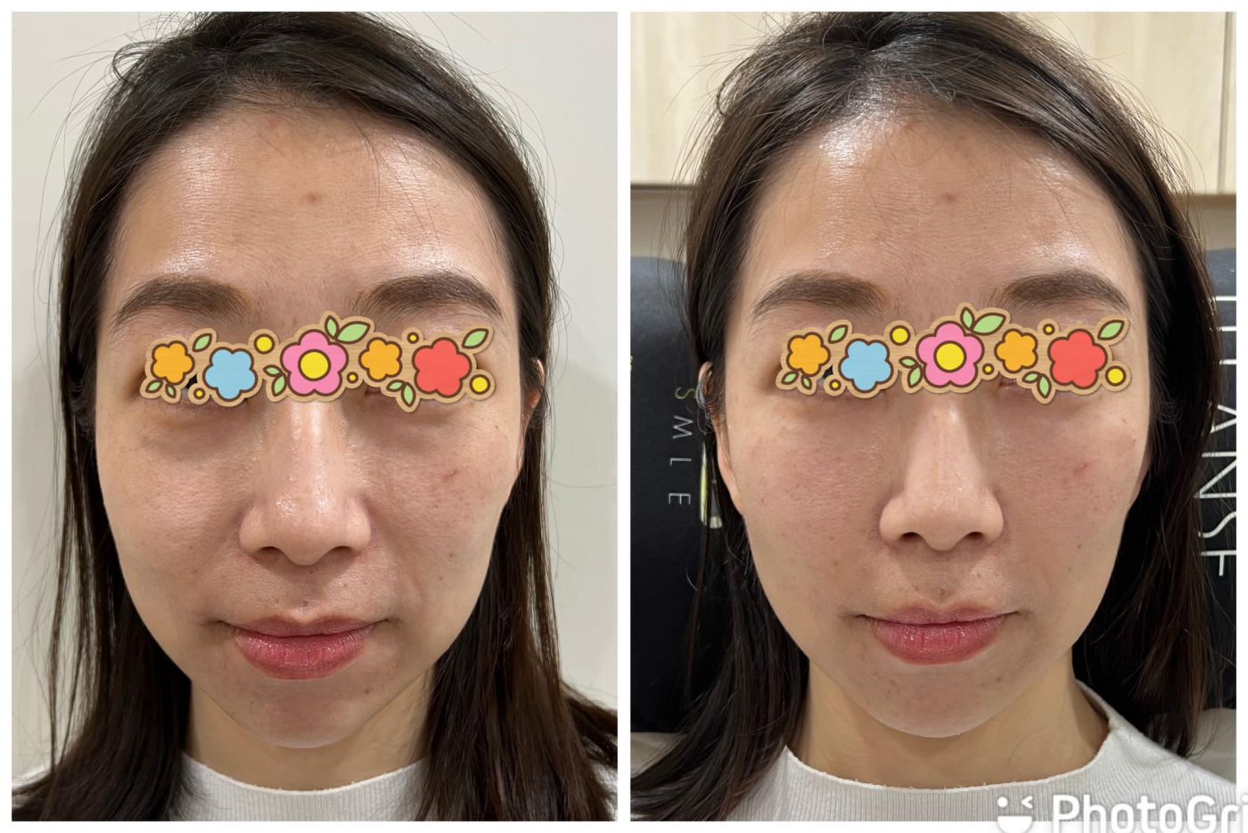 產後媽咪淚溝黑眼圈法令紋治療案例｜玻尿酸+熊貓針複合方案｜許惠翔醫師｜妍回美學診所