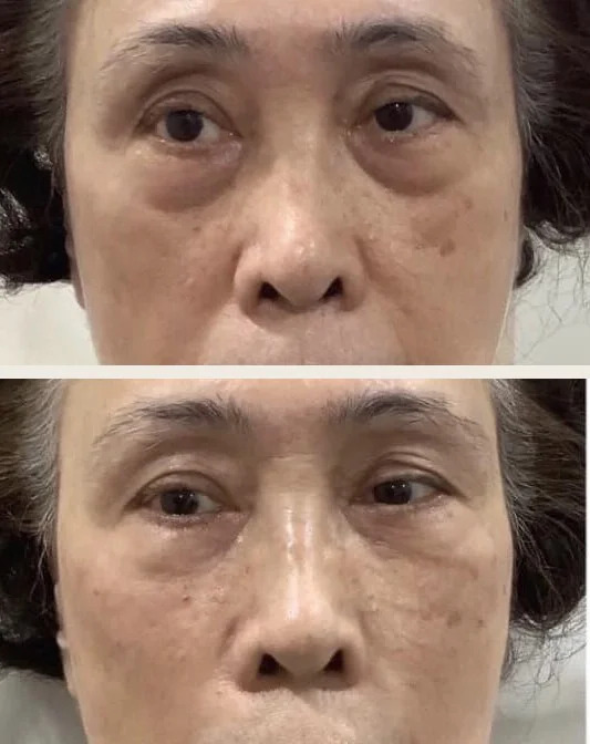 70 歲個案眼袋合併法令紋，上：治療前；下：少女針與玻尿酸填補後，眼下平順｜妍回美學診所
