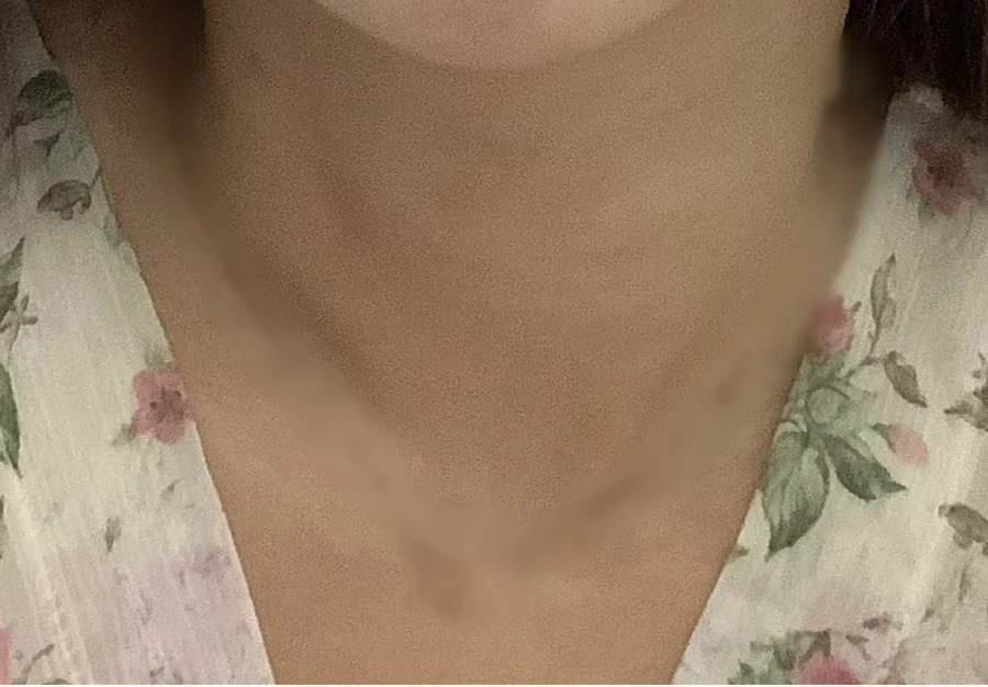項鍊紋個案治療後：玻尿酸與少女針治療後，橫紋變淺｜妍回美學診所